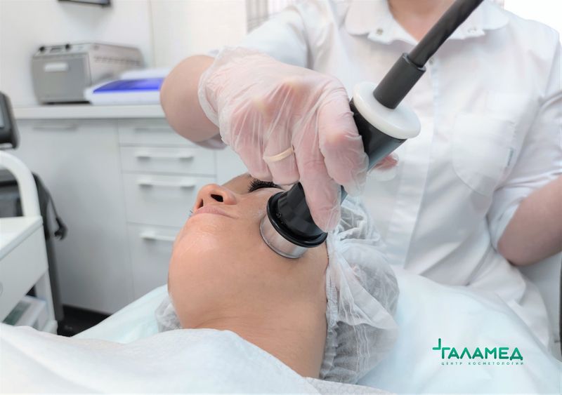 RF – лифтинг по лицу Intraderma