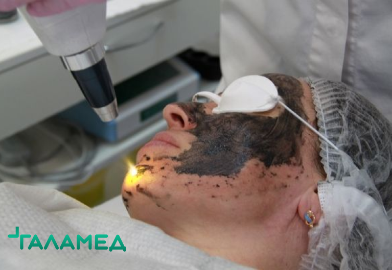 Карбоновый пилинг Цент Косметологии "Галамед" Карбоновый пилинг Цент Косметологии "Галамед"